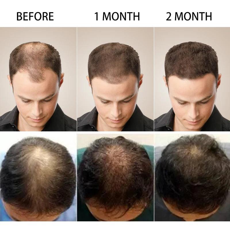 Purc hair density growth products prevent hair loss oil for Men Women - ARI